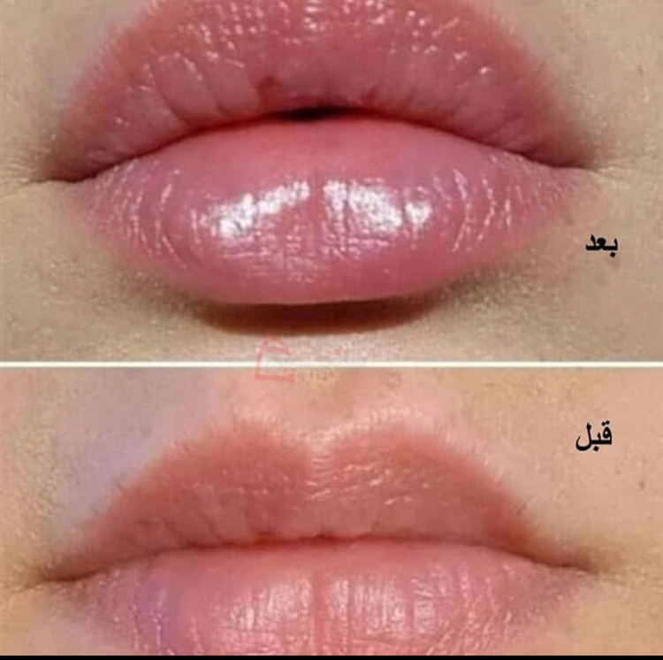 حجم دهنده لب آمپولی کیس بیوتی اورجینال ۲۰۲۶